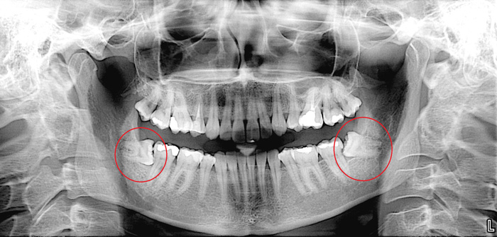 Impacted growing teeth